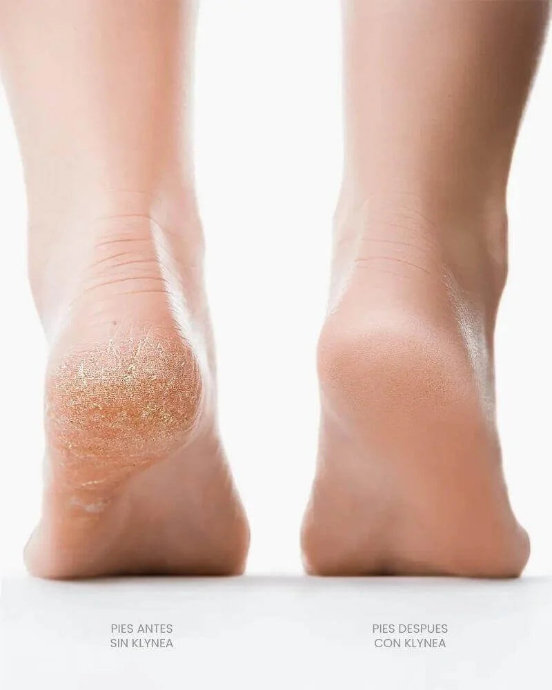 Removedor de Callos Klynea