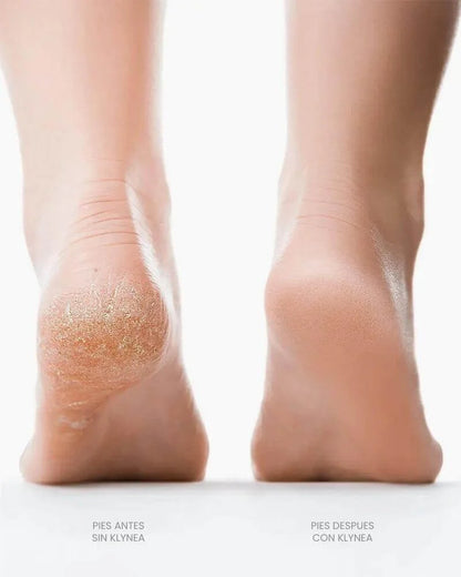 Removedor de Callos Klynea